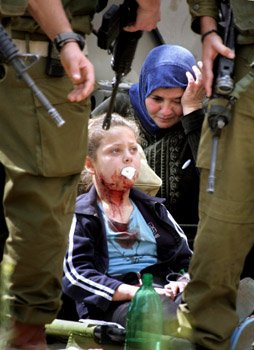 8-year-old Nisreen abu Hashash was shot in the face with a rubber bullet in the West Bank city of Hebron on March 28, 2006.