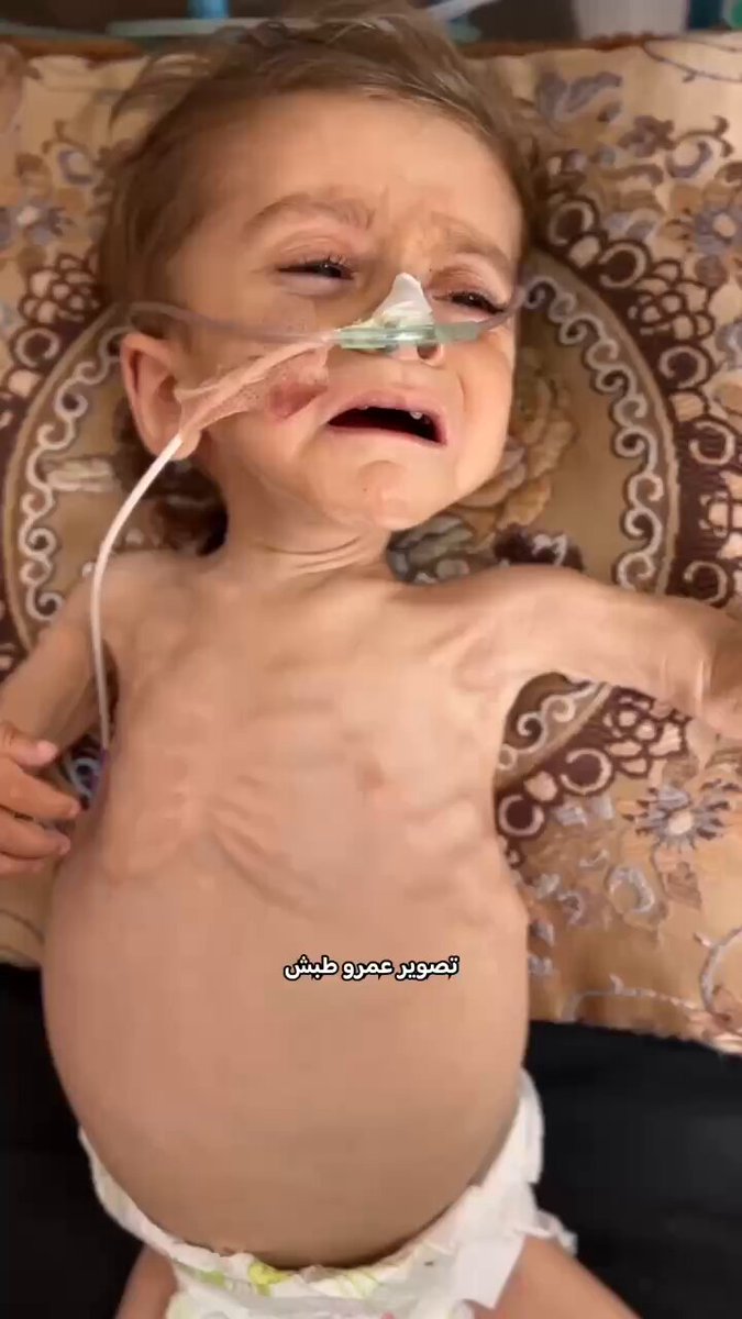 Kareem is three years old, severely malnourished